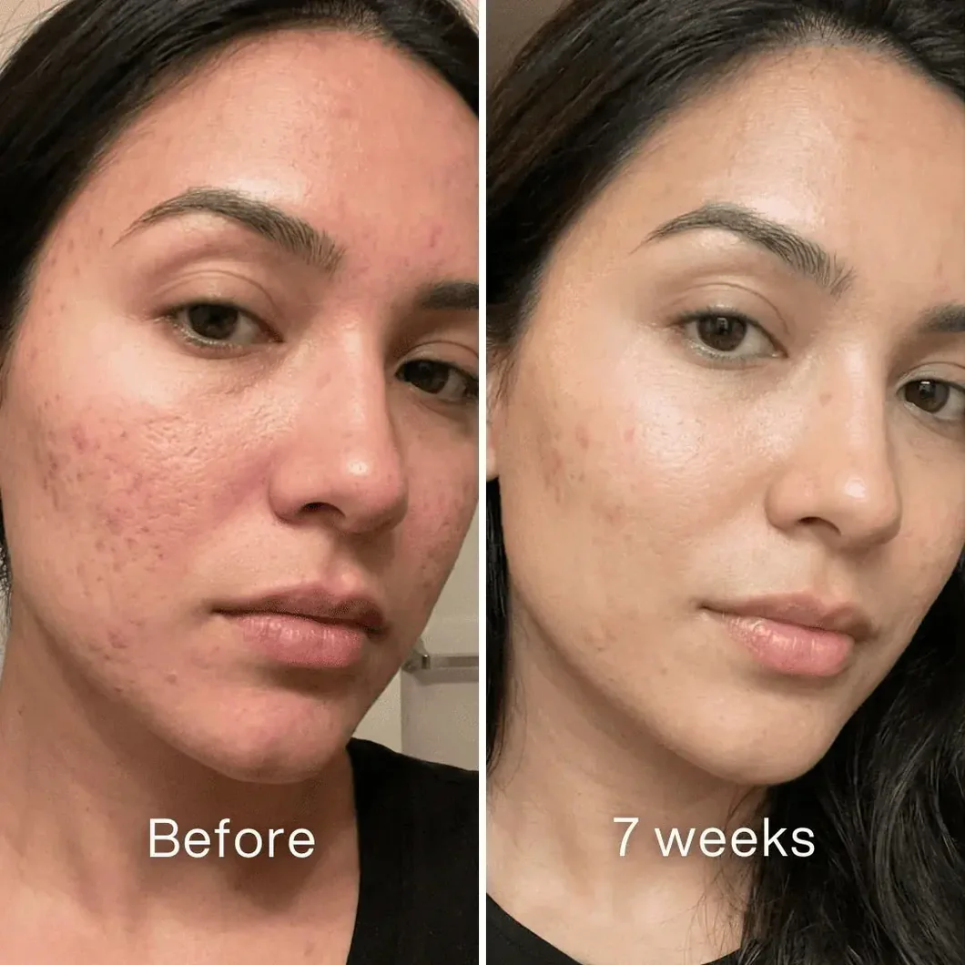 Clinical Acne Scar Repair Balm