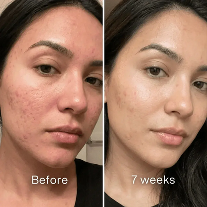 Clinical Acne Scar Repair Balm