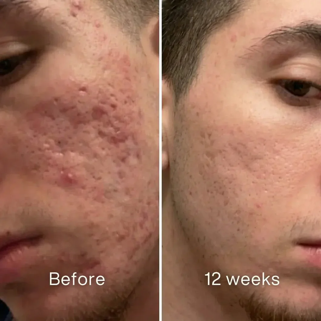 Clinical Acne Scar Repair Balm